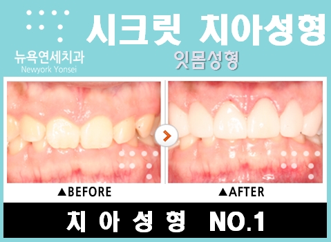  잇몸성형비용,잇몸성형,잇몸성형잘하는치과,거미스마일잇몸성형