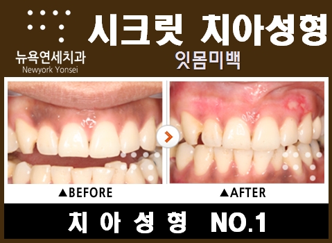  잇몸미백비용,잇몸미백,잇몸미백가격,잇몸미백방법