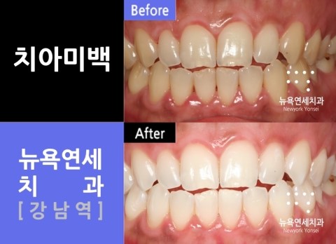 치아미백이벤트,치아미백이벤트비용,치아미백이벤트치과,치아미백제품