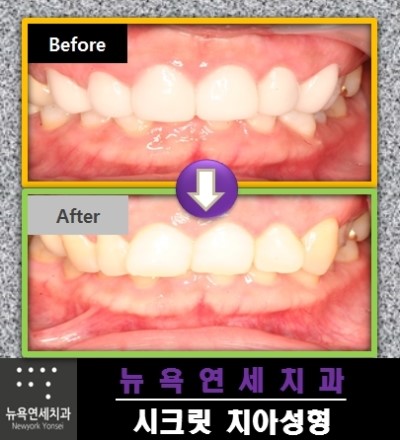  치아성형비용,라미네이트치아성형,라미네이트치아성형비용,앞니치아성형비용