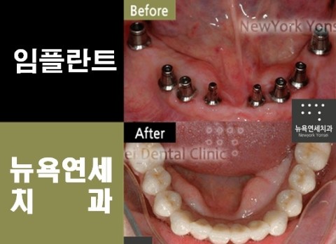  임플란트수술가격,임플란트수술,임플란트수술방법,임플란트수술비용
