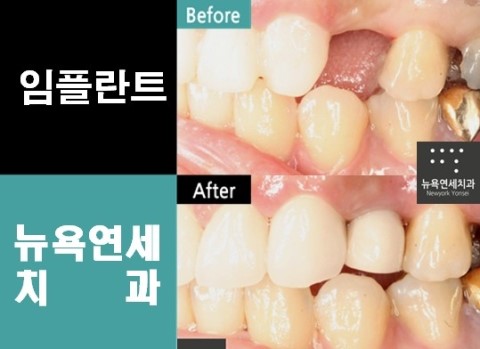  임플란트시술비용,임플란트시술,임플란트시술방법,임플란트시술후