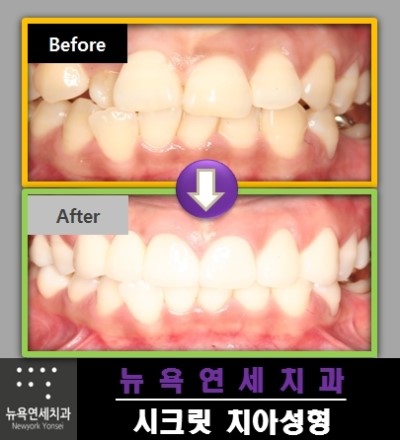  송곳니교정비용,송곳니교정,송곳니치아교정가격,송곳니치아교정