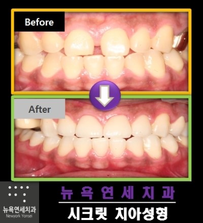  벌어진앞니교정비용,벌어진앞니교정,벌어진앞니교정치과,벌어진앞니교정가격