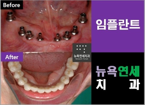 어금니임플란트시술비용,어금니임플란트시술,어금니임플란트수술비용,어금니임플란트시술가격