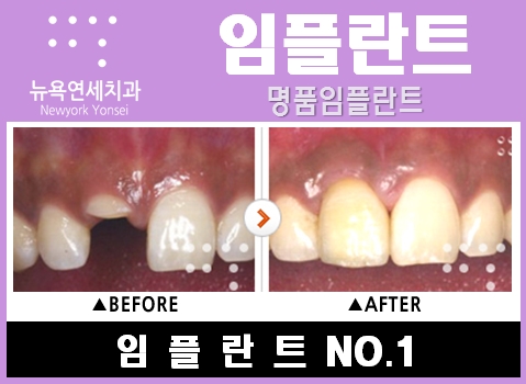  앞니임플란트수술비용,앞니임플란트수술,앞니임플란트수술방법,앞니임플란트수술가격