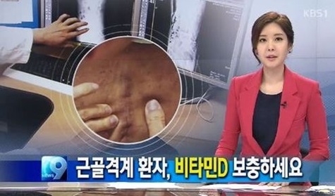 비타민 D 결핍증, 뼈의 변형이 생기는 질환! 예방법은? 비타민 D 결핍증, 뼈의 변형이 생기는 질환! 예방법은?