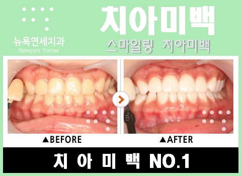  앞니치아미백비용,앞니치아미백,앞니치아미백가격,앞니치아미백치과