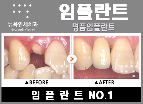  당일임플란트비용,당일임플란트수술,즉시임플란트비용,즉시임플란트시술
