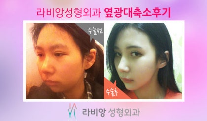 라비앙성형외과의 옆광대축소후기 : 네이버 블로그