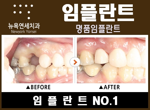  임플란트수술치과,임플란트수술,임플란트수술과정,임플란트수술비용