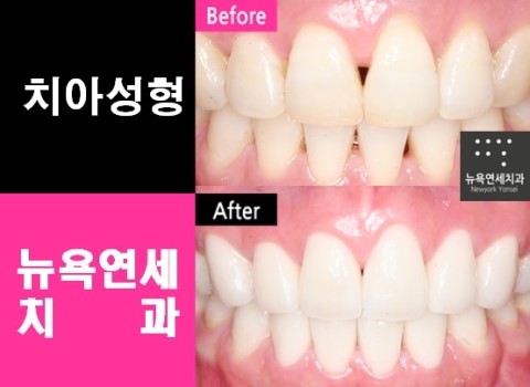  앞니라미네이트비용,앞니라미네이트,앞니라미네이트잘하는곳,앞니라미네이트치과