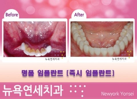  강남임플란트치과,임플란트치과,임플란트치과비용,임플란트수술비용