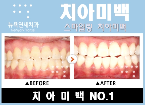  치아미백치과,치아미백,치아미백잘하는치과,치아미백비용