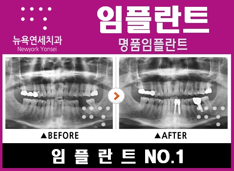  뼈이식임플란트수술비용,뼈이식임플란트수술,임플란트수술가격,뼈이식임플란트시술