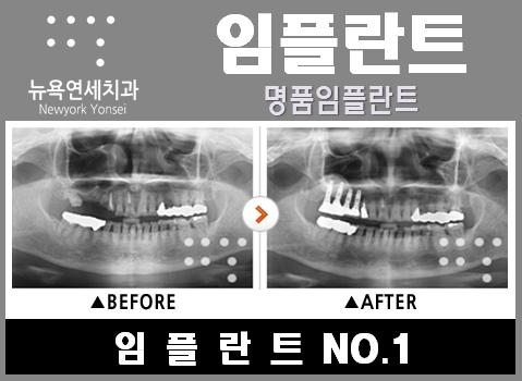  어금니임플란트수술비용,어금니임플란트수술,어금니임플란트시술,어금니임플란트시술가격