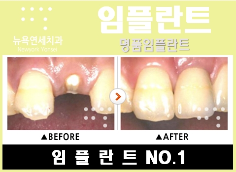  즉시임플란트치과,즉시임플란트,즉시임플란트수술,즉시임플란트시술비용