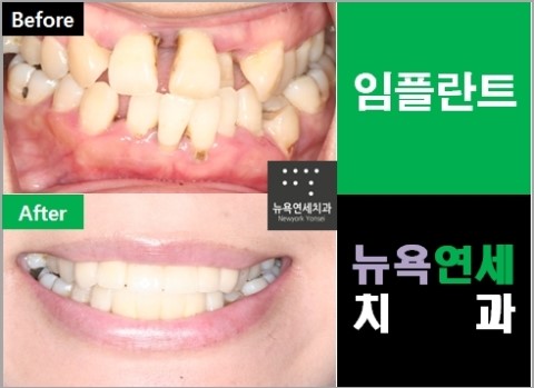  앞니임플란트수술방법,앞니임플란트수술,앞니임플란트치료비용,앞니임플란트시술가격