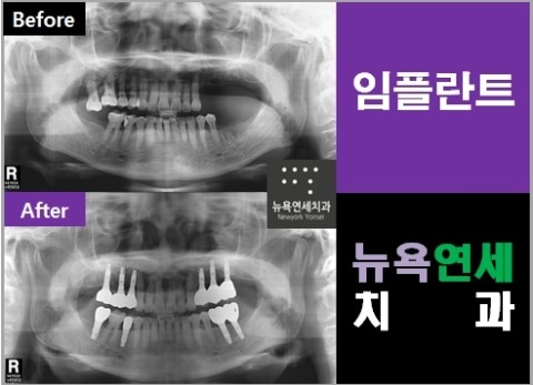  임플란트가격비교,임플란트가격,임플란트가격싼곳,임플란트비용저렴한곳