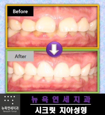  벌어진앞니교정,벌어진앞니,벌어진앞니라미네이트,벌어진앞니치아성형