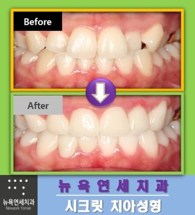  앞니교정비용,앞니교정,앞니교정비용저렴한곳,앞니교정비용싼곳