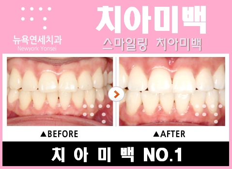  치아미백후기,치아미백비용,치아미백이벤트가격,치아미백이벤트치과