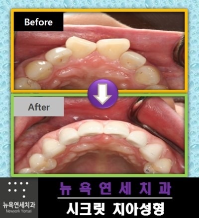  앞니교정치료,앞니교정비용,앞니교정비용저렴한치과,앞니교정이벤트
