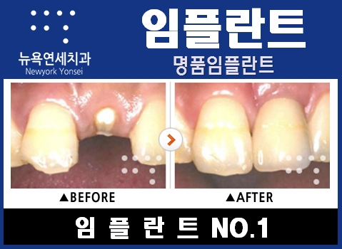  임플란트수술방법,임플란트수술,임플란트수술비용,임플란트수술잘하는치과