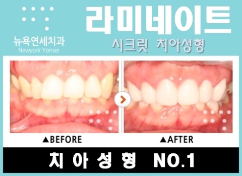  앞니라미네이트비용,앞니라미네이트시술,앞니라미네이트시술비용,앞니라미네이트치아성형비용