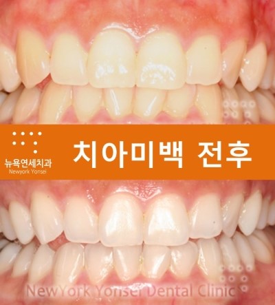 치아미백효과,치아미백,치아미백비용,치아미백제품