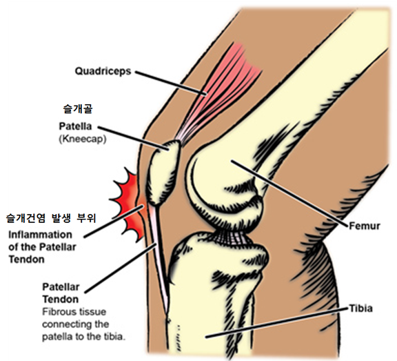 슬개골염 자전거