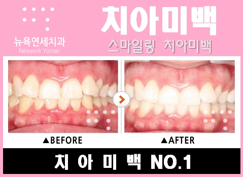  원데이치아미백비용,원데이치아미백,원데이치아미백효과,원데이치아미백가격