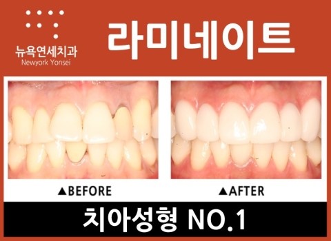  앞니교정비용,앞니교정비용싼곳,앞니교정방법,앞니교정라미네이트