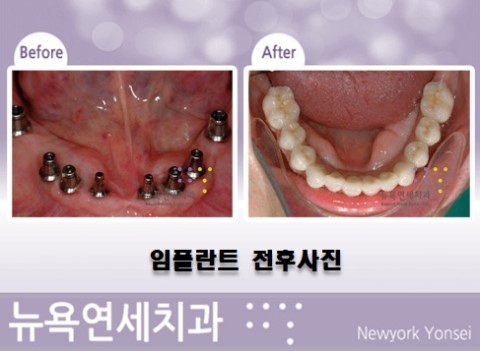  임플란트시술비용,임플란트시술,임플란트수술가격,임플란트수술