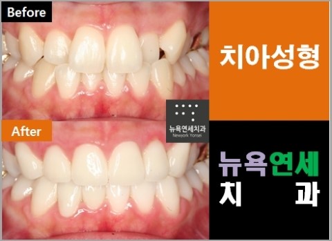  올세라믹치료비용,올세라믹치료,올세라믹앞니성형,올세라믹치아성형