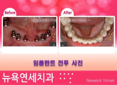  임플란트수술후,임플란트수술,임플란트수술비용,임플란트수술과정