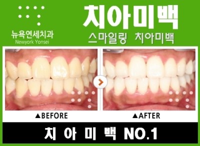  연예인치아미백종류,연예인치아미백,연예인치아미백치과,연예인치아미백비용