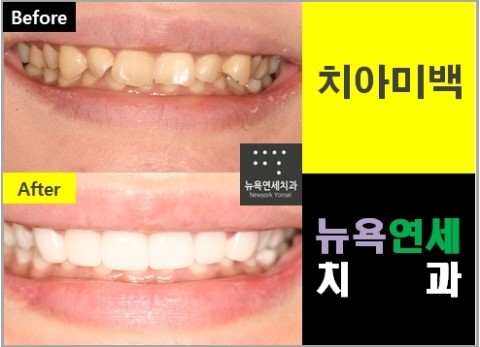  앞니라미네이트가격싼곳,앞니라미네이트가격,앞니라미네이트가격이벤트,앞니라미네이트비용