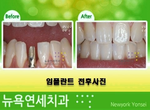  앞니임플란트수술,앞니임플란수술비용,심미임플란트비용,심미임플란트재건술