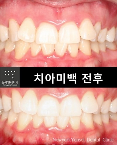  치아미백치과,치아미백치과비용,치아미백치과추천,미백치과비용
