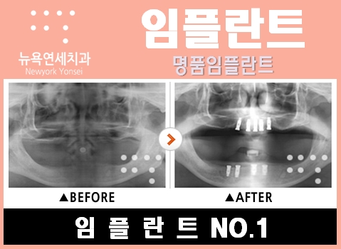  어금니임플란트비용,어금니임플란트,어금니임플란트시술,어금니임플란트잘하는치과