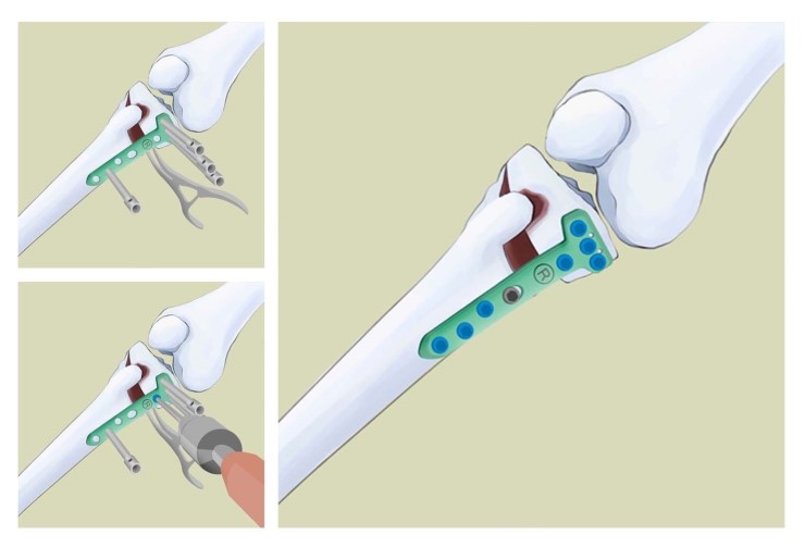  메디컬일러스트ㅣ근위경골 절골술 [High Tibial Osteotomy]