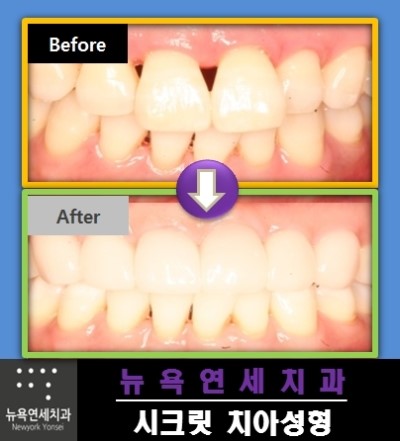 블랙트라이앵글치료,치아교정후블랙트라이앵글,블랙트라이앵글치료방법,블랙트라이앵글라미네이트