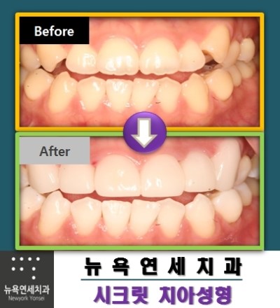  덧니성형,덧니성형비용,덧니치아성형,덧니올세라믹