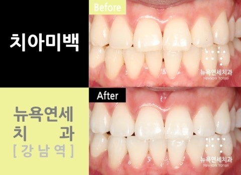 치아미백비용,치아미백비용저렴한곳,치아미백,치아미백비용싼곳