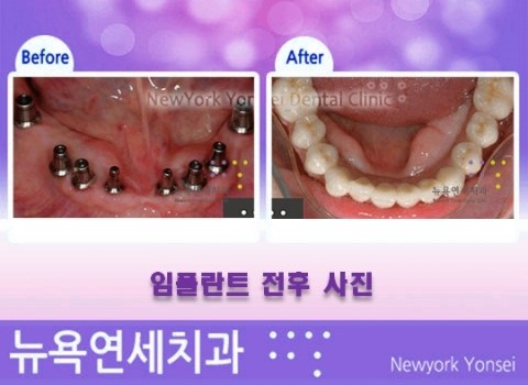  임플란트치료방법,임플란트치료,임플란트치료비용,임플란트치과치료