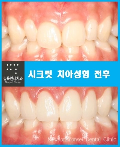  앞니성형치과,앞니성형,앞니성형잘하는곳,앞니성형라미네이트