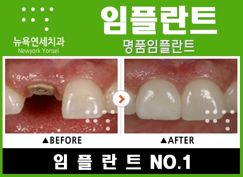  임플란트치료기간,임플란트치료,임플란트수술기간,임플란트수술전후