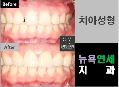  벌어진앞니라미네이트,앞니라미네이트비용,벌어진앞니치아성형,치아성형유명한곳