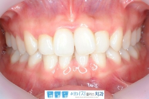 서면 정상교합치료 교정치과 정상교합을 2